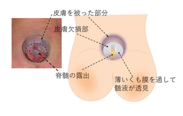 図1上段：顕在性（開放性）二分脊椎、脊髄髄膜瘤