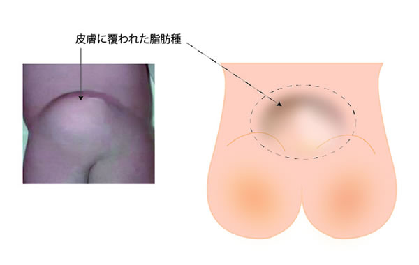 脊髄脂肪腫皮膚