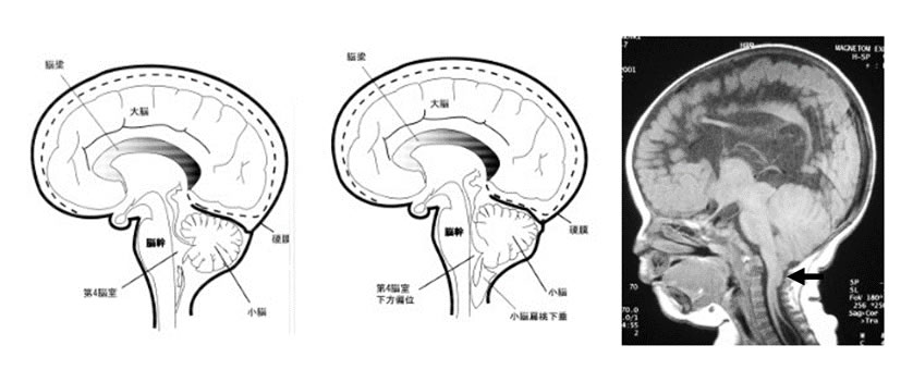 図1上段:顕在性(開放性)二分脊椎、脊髄髄膜瘤