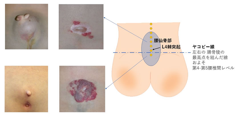 潜在性二分脊椎(あるいは閉鎖性二分脊椎)